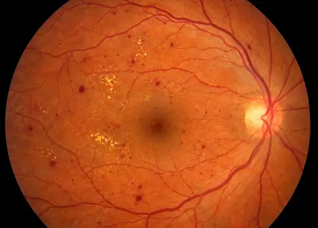 Imagem ilustrativa de retinopatia diabética